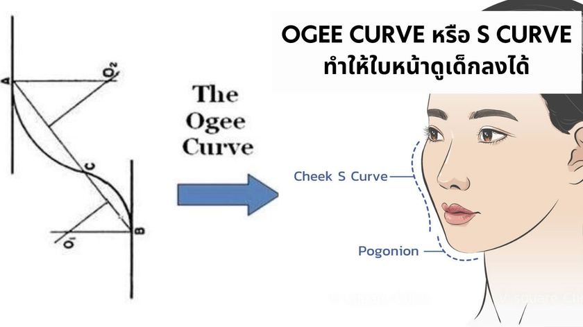 Ogee curve ฟิลเลอร์แก้มส้ม
