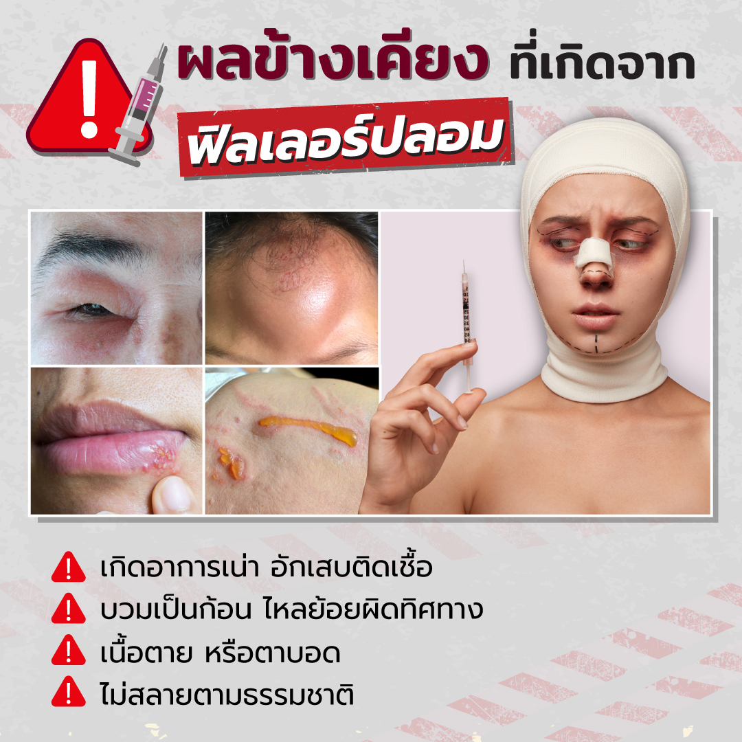 ผลเสียฟิลเลอร์ปลอม